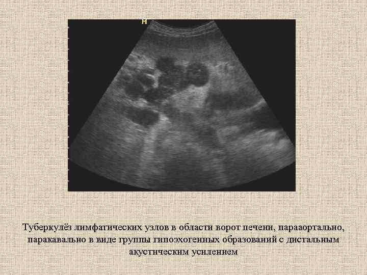 Туберкулёз лимфатических узлов в области ворот печени, парааортально, паракавально в виде группы гипоэхогенных образований