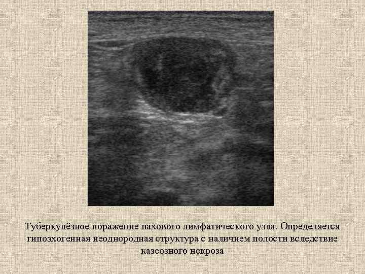 Туберкулёзное поражение пахового лимфатического узла. Определяется гипоэхогенная неоднородная структура с наличием полости вследствие казеозного