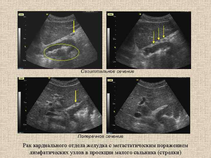 Сагиттальное сечение Поперечное сечение Рак кардиального отдела желудка с метастатическим поражением лимфатических узлов в