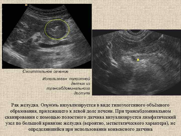 Сагиттальное сечение Использован полостной датчик из трансабдоминального доступа Рак желудка. Опухоль визуализируется в виде