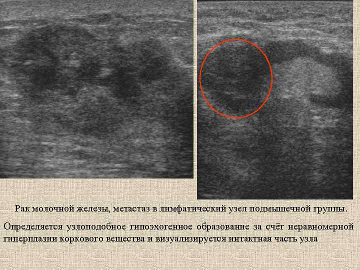 Рак молочной железы, метастаз в лимфатический узел подмышечной группы. Определяется узлоподобное гипоэхогенное образование за