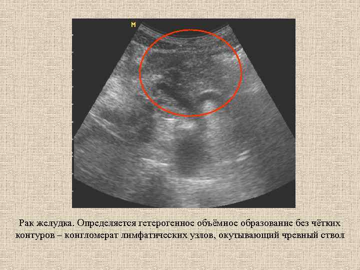 Рак желудка. Определяется гетерогенное объёмное образование без чётких контуров – конгломерат лимфатических узлов, окутывающий
