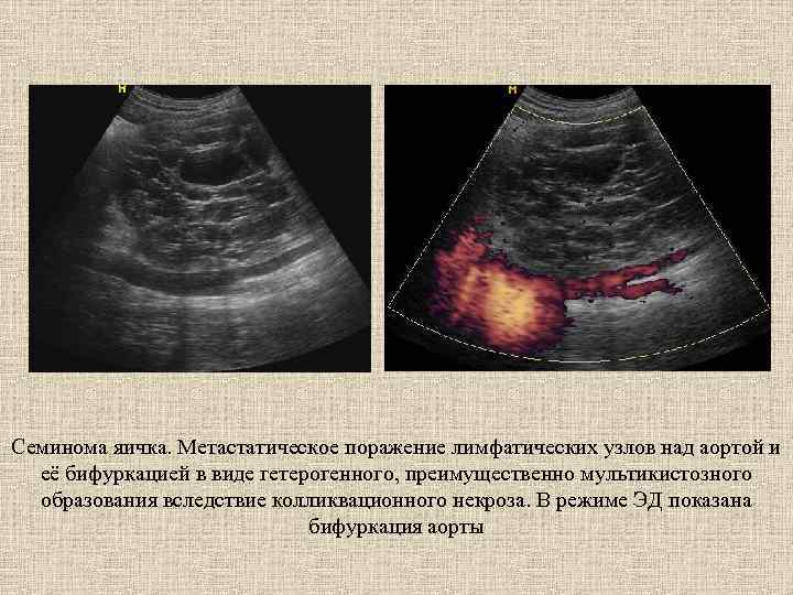 Семинома яичка. Метастатическое поражение лимфатических узлов над аортой и её бифуркацией в виде гетерогенного,