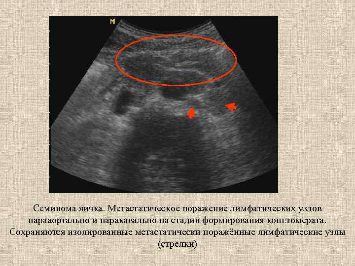 Семинома яичка. Метастатическое поражение лимфатических узлов парааортально и паракавально на стадии формирования конгломерата. Сохраняются