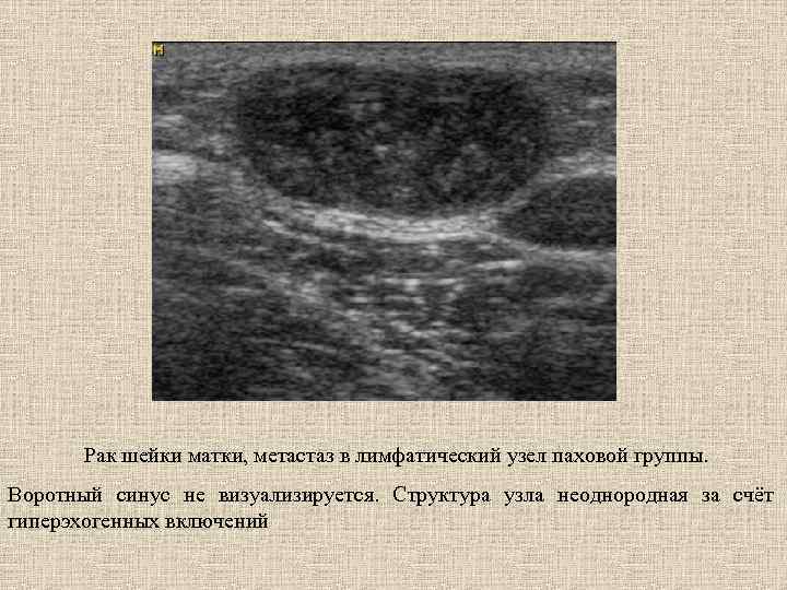 Рак шейки матки, метастаз в лимфатический узел паховой группы. Воротный синус не визуализируется. Структура
