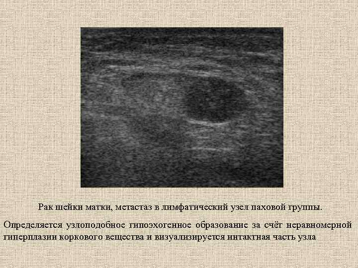 Рак шейки матки, метастаз в лимфатический узел паховой группы. Определяется узлоподобное гипоэхогенное образование за