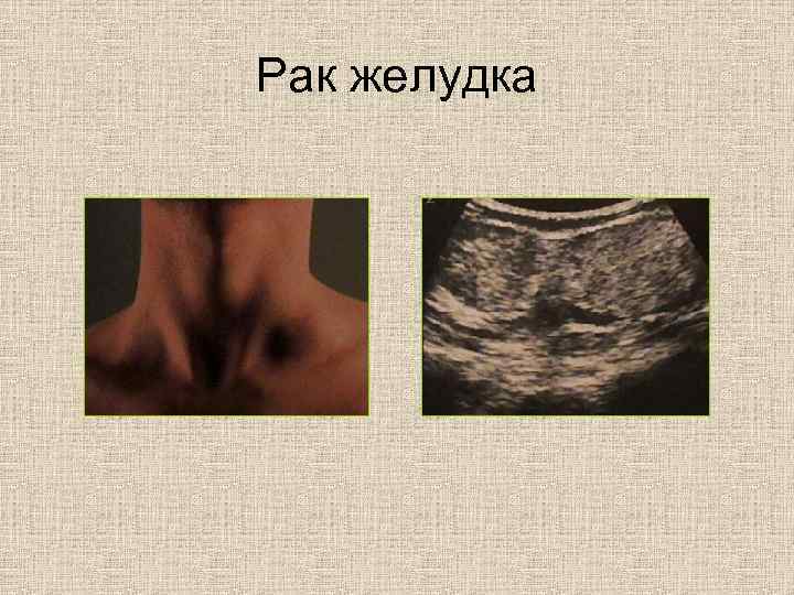 Рак желудка 