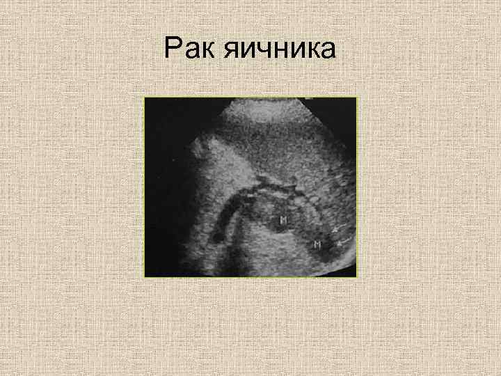 Рак яичника 