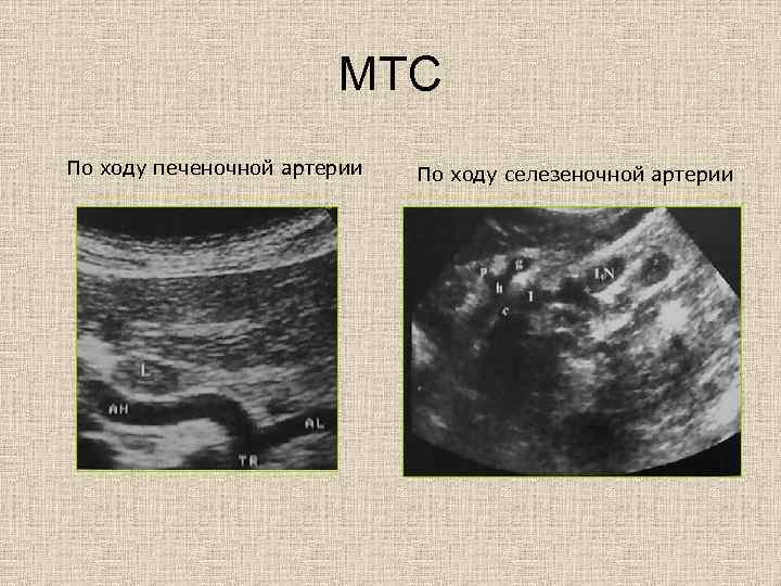 МТС По ходу печеночной артерии По ходу селезеночной артерии 
