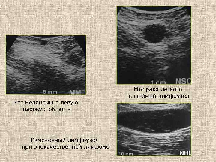 Мтс рака легкого в шейный лимфоузел Мтс меланомы в левую паховую область Измененный лимфоузел