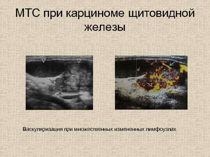 МТС при карциноме щитовидной железы Васкуляризация при множественных измененных лимфоузлах 
