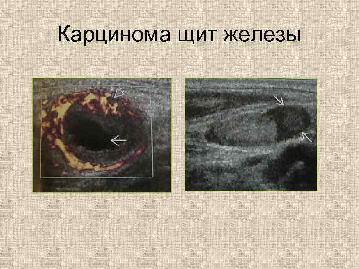 Карцинома щит железы 