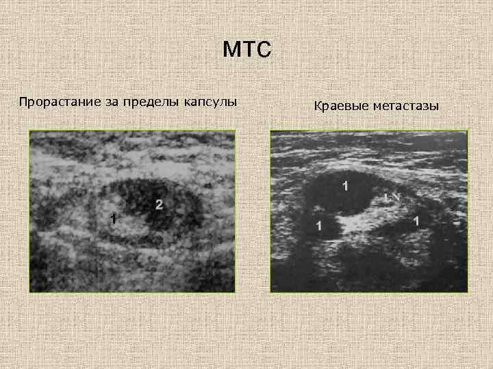 мтс Прорастание за пределы капсулы Краевые метастазы 