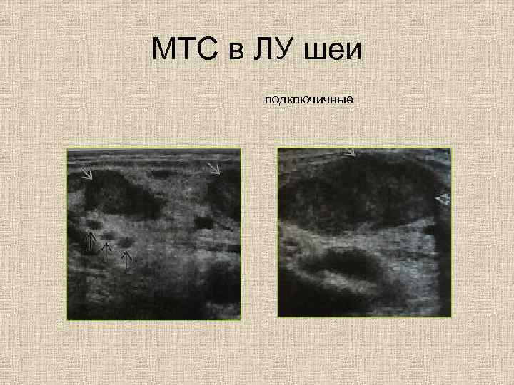МТС в ЛУ шеи подключичные 