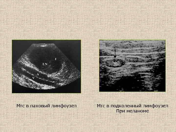 Мтс в паховый лимфоузел Мтс в подколенный лимфоузел При меланоме 