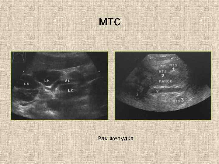 мтс Рак желудка 