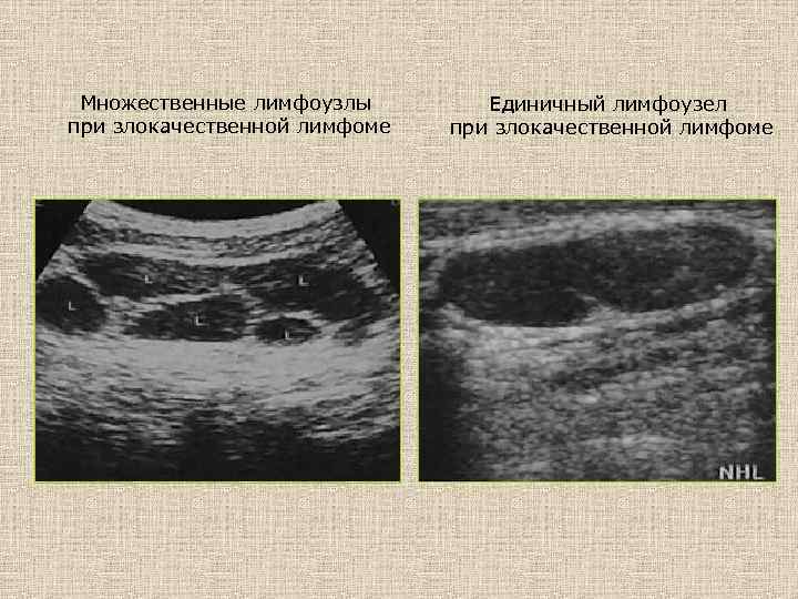 Множественные лимфоузлы при злокачественной лимфоме Единичный лимфоузел при злокачественной лимфоме 