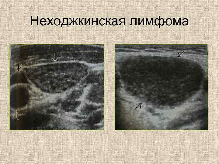 Неходжкинская лимфома 