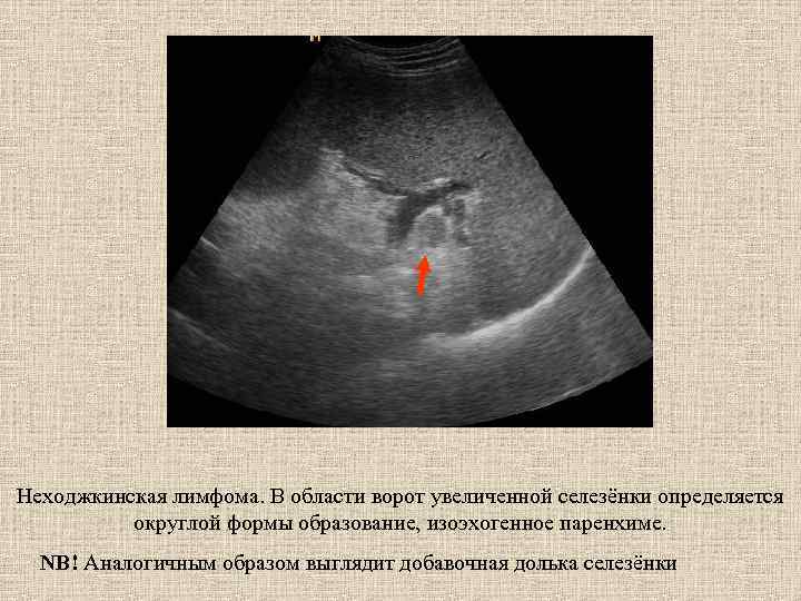 Неходжкинская лимфома. В области ворот увеличенной селезёнки определяется округлой формы образование, изоэхогенное паренхиме. NB!