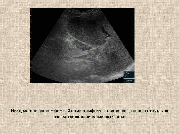 Неходжкинская лимфома. Форма лимфоузла сохранена, однако структура изоэхогенна паренхиме селезёнки 