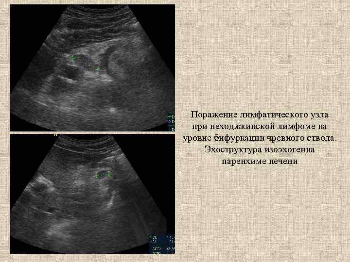 Поражение лимфатического узла при неходжкинской лимфоме на уровне бифуркации чревного ствола. Эхоструктура изоэхогенна паренхиме