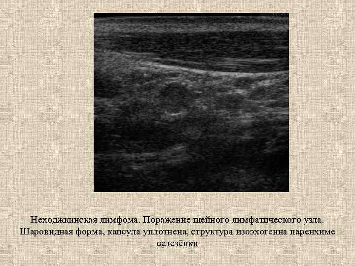 Неходжкинская лимфома. Поражение шейного лимфатического узла. Шаровидная форма, капсула уплотнена, структура изоэхогенна паренхиме селезёнки