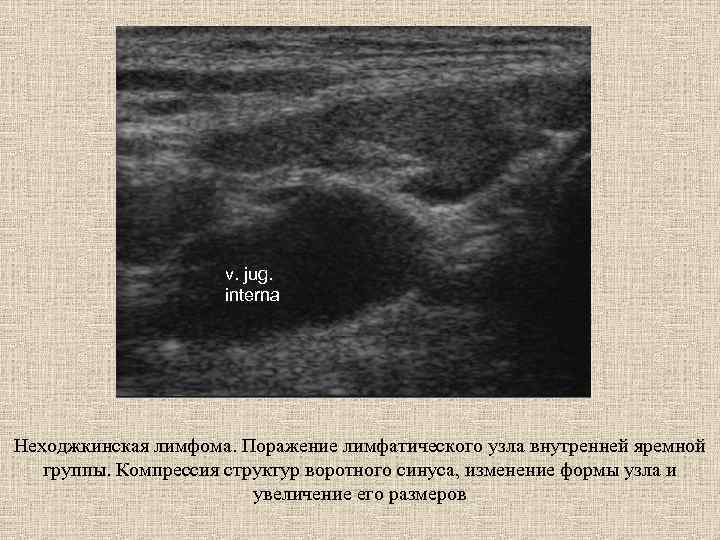 v. jug. interna Неходжкинская лимфома. Поражение лимфатического узла внутренней яремной группы. Компрессия структур воротного