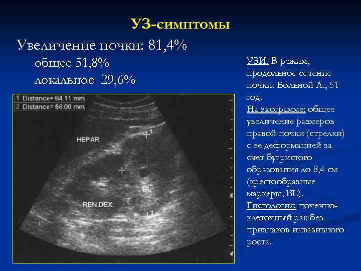 УЗ-симптомы Увеличение почки: 81, 4% общее 51, 8% локальное 29, 6% УЗИ. В-режим, продольное