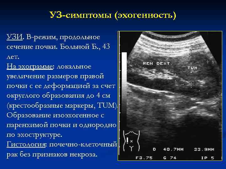 УЗ-симптомы (эхогенность) УЗИ. В-режим, продольное сечение почки. Больной Б. , 43 лет. На эхограмме: