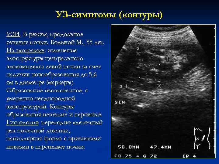 УЗ-симптомы (контуры) УЗИ. В-режим, продольное сечение почки. Больной М. , 55 лет. На эхограмме: