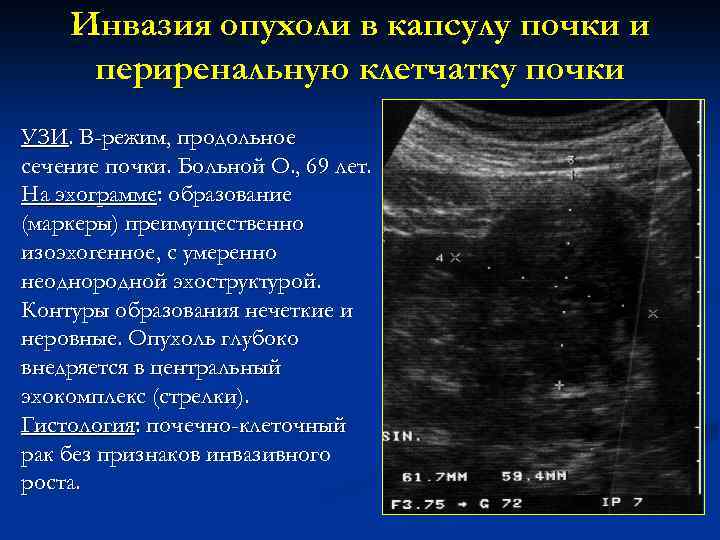 Инвазия опухоли в капсулу почки и периренальную клетчатку почки УЗИ. В-режим, продольное сечение почки.