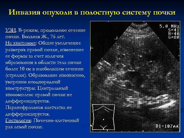 Инвазия опухоли в полостную систему почки УЗИ. В-режим, продольное сечение почки. Больная Ж. ,