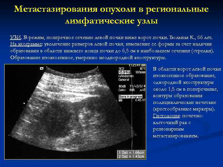 Метастазирования опухоли в региональные лимфатические узлы УЗИ. В-режим, поперечное сечение левой почки ниже ворот