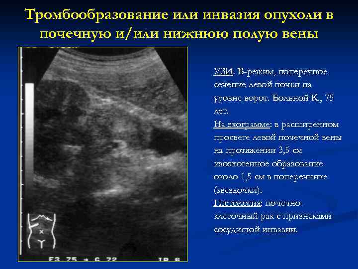Тромбообразование или инвазия опухоли в почечную и/или нижнюю полую вены * УЗИ. В-режим, поперечное