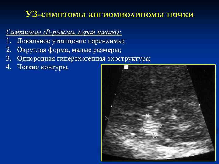 УЗ-симптомы ангиомиолипомы почки Симптомы (В-режим, серая шкала): 1. Локальное утолщение паренхимы; 2. Округлая форма,