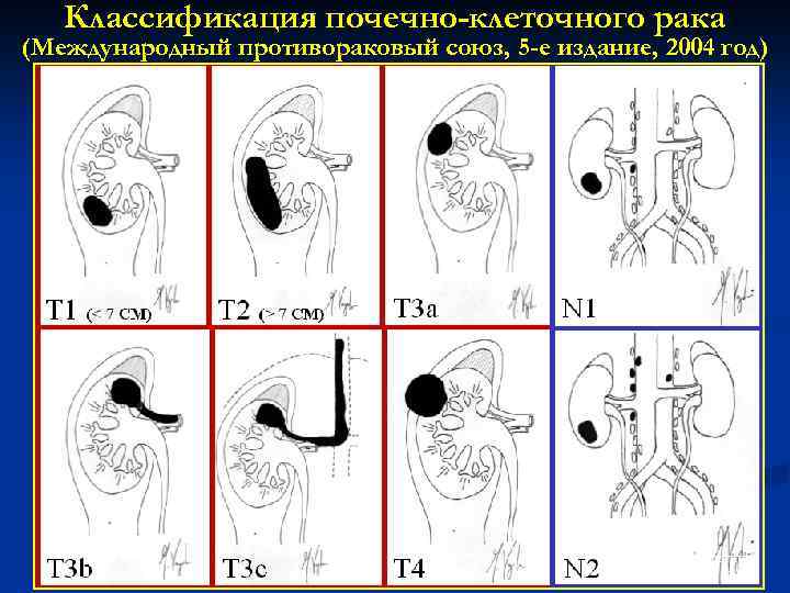 Классификация почечно-клеточного рака (Международный противораковый союз, 5 -е издание, 2004 год) Radiology Institute University