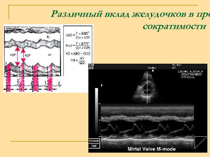 Различный вклад желудочков в про сократимости 