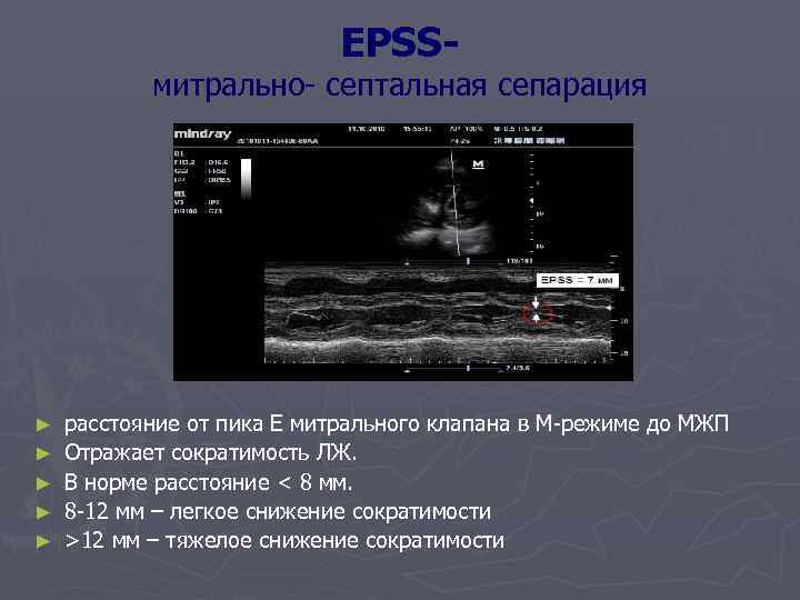 EPSS- митрально- септальная сепарация ► ► ► расстояние от пика Е митрального клапана в