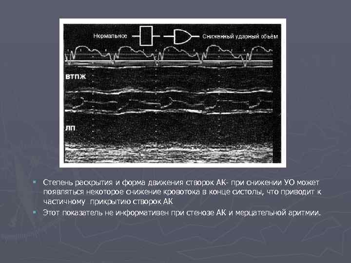 § Степень раскрытия и форма движения створок АК- при снижении УО может появляться некоторое