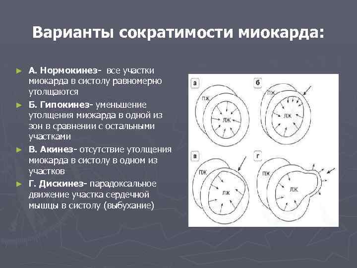 Варианты сократимости миокарда: А. Нормокинез- все участки миокарда в систолу равномерно утолщаются ► Б.