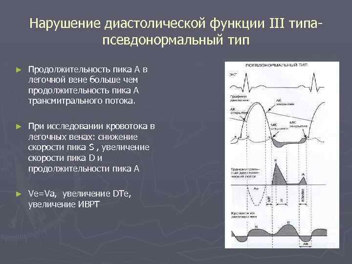 Нарушение диастолической функции III типапсевдонормальный тип ► Продолжительность пика А в легочной вене больше