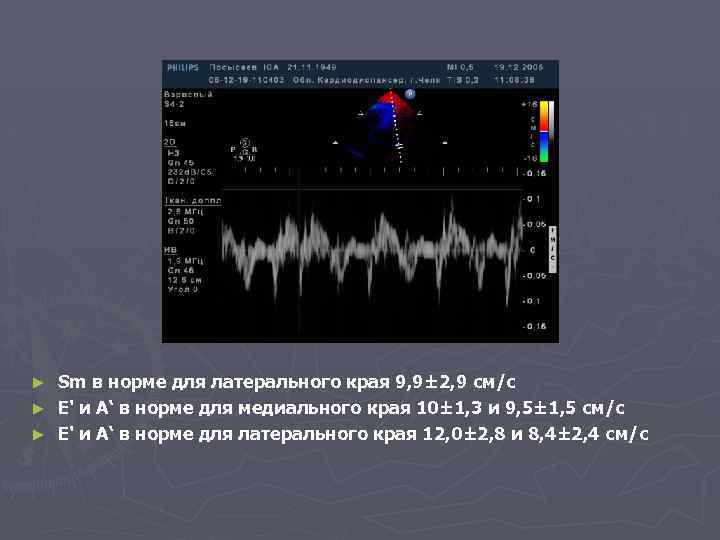 Sm в норме для латерального края 9, 9± 2, 9 см/с ► E' и
