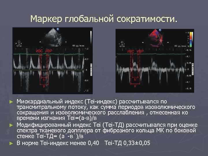 Маркер глобальной сократимости. Миокардиальный индекс (Tei-индекс) рассчитывался по трансмитральному потоку, как сумма периодов изоволюмического