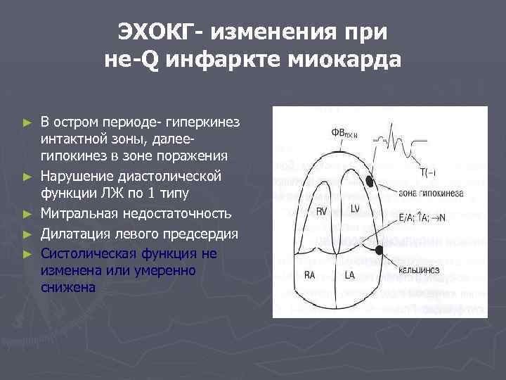 ЭХОКГ- изменения при не-Q инфаркте миокарда ► ► ► В остром периоде- гиперкинез интактной