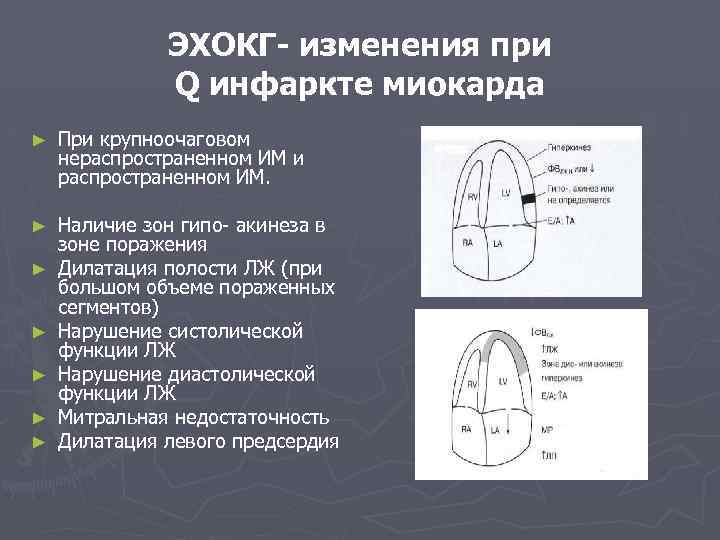 ЭХОКГ- изменения при Q инфаркте миокарда ► При крупноочаговом нераспространенном ИМ и распространенном ИМ.