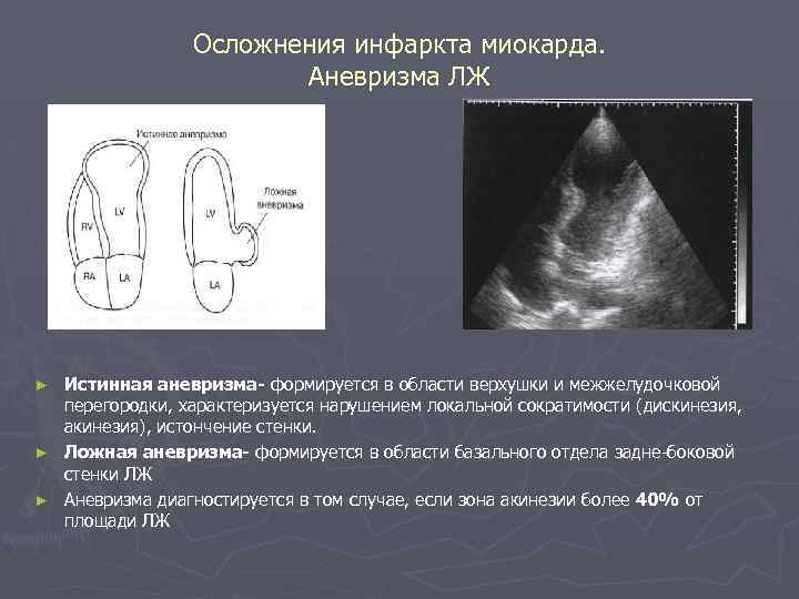 Осложнения инфаркта миокарда. Аневризма ЛЖ Истинная аневризма- формируется в области верхушки и межжелудочковой перегородки,