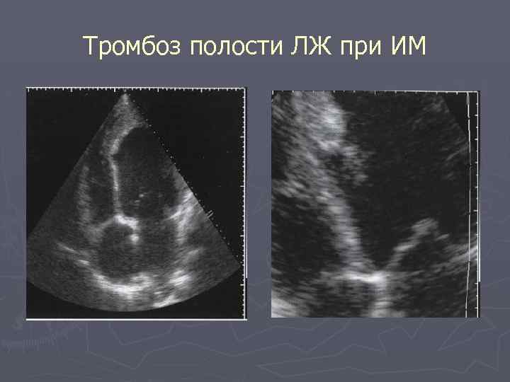 Тромбоз полости ЛЖ при ИМ 