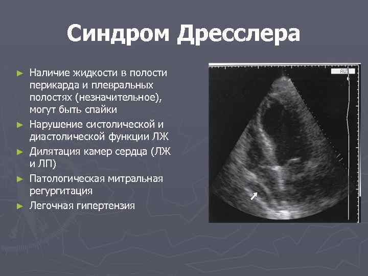 Синдром Дресслера ► ► ► Наличие жидкости в полости перикарда и плевральных полостях (незначительное),