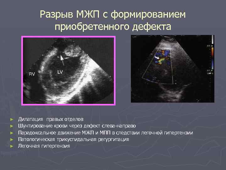 Разрыв МЖП с формированием приобретенного дефекта ► ► ► Дилатация правых отделов Шунтирование крови
