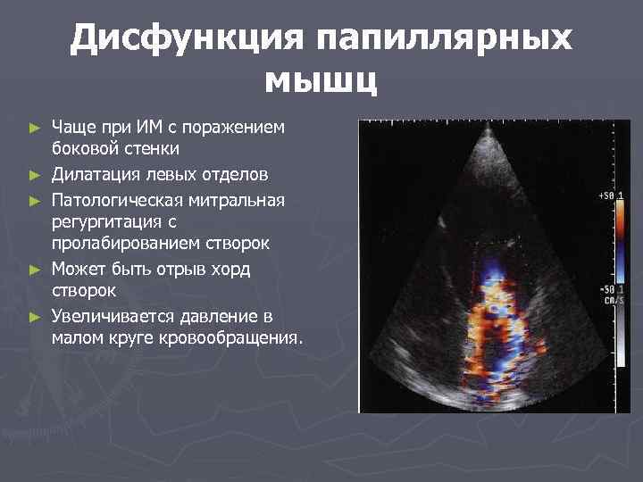 Дисфункция папиллярных мышц ► ► ► Чаще при ИМ с поражением боковой стенки Дилатация